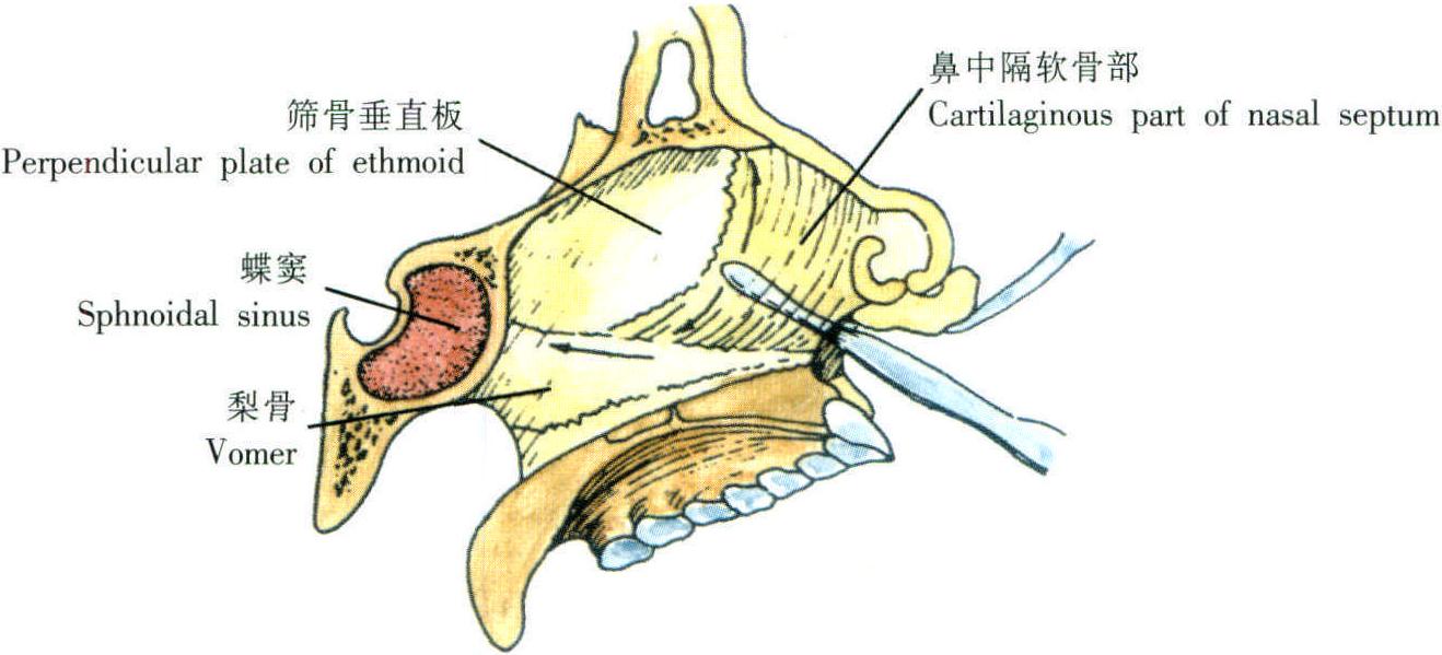 經(jīng)蝶竇顱咽管瘤切除術(shù)